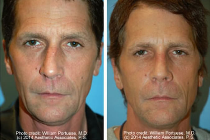 Rhinoplasty Cost